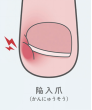 診察時、以下のような爪・足指の状態の場合には治療開始ができません。