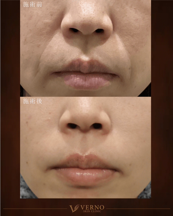 ほうれい線（ヒアルロン酸） 症例1