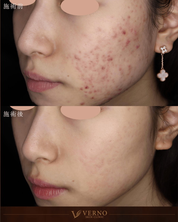 ニキビ・ニキビ跡 症例1