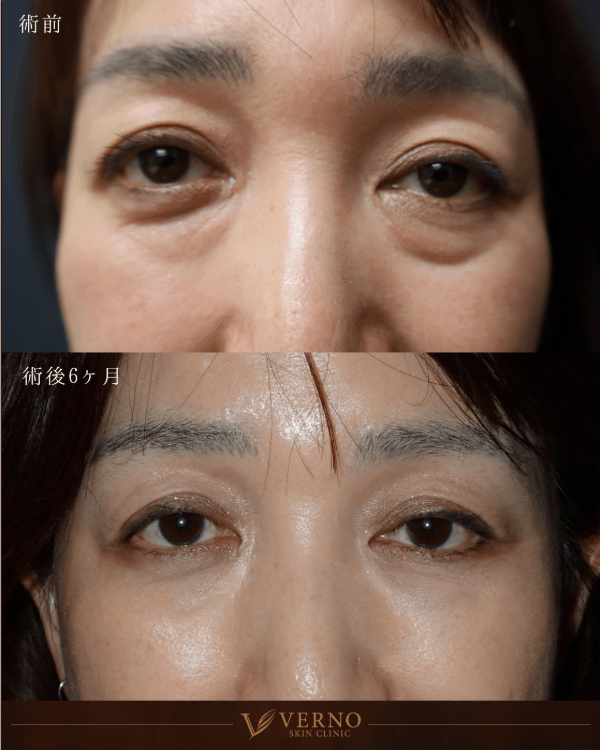 クマ取り（裏ハムラ） 症例1